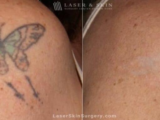 Laser Tattoo Removal