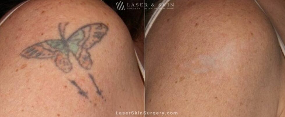 Laser Tattoo Removal: What It Is, How It Works, and What to Expect ...