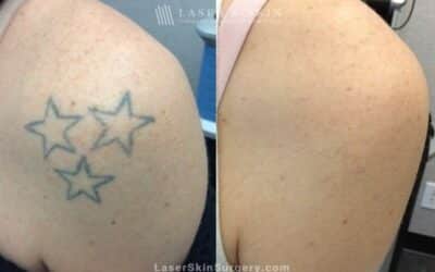 4 Reasons to Consider Laser Treatments for Removing Unwanted Tattoos