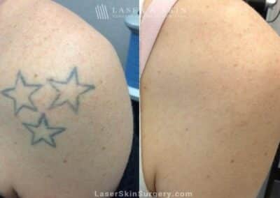 Laser Tattoo Removal