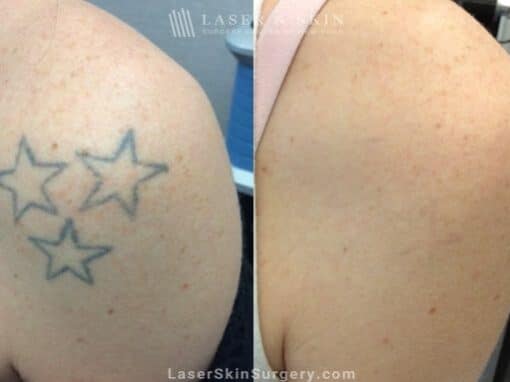 Laser Tattoo Removal