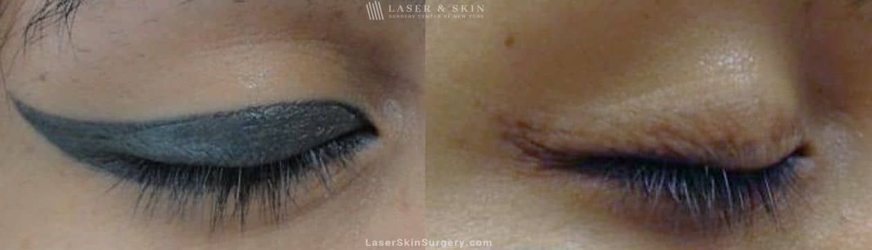 lsscny laser tattoo removal eyelid before and after new york ny