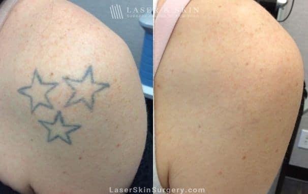 Winter – Best Time For Laser Tattoo Removal – Blog – Profile Studios