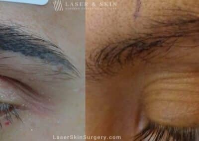 Laser Tattoo Removal for Eyebrow Tattoo