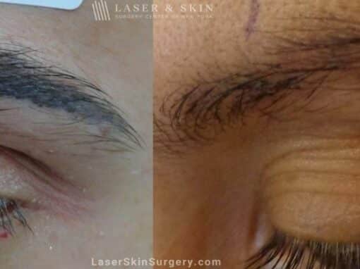 Laser Tattoo Removal for Eyebrow Tattoo