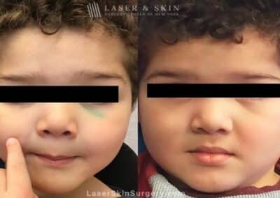 Laser Tattoo Removal for Traumatic Tattoo