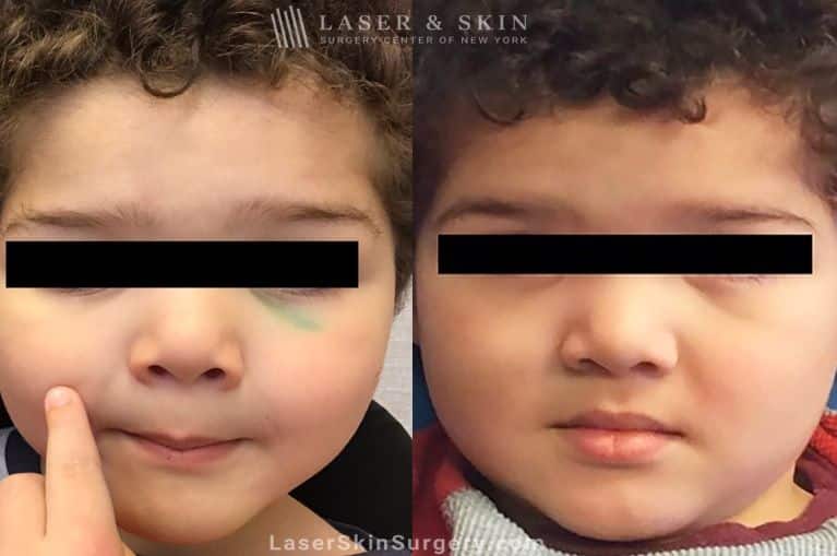 Laser Tattoo Removal for Traumatic Tattoo