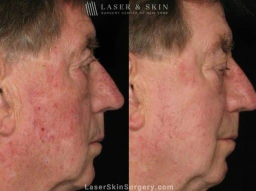 Vascular laser used to reduce visible vessels on patient’s face