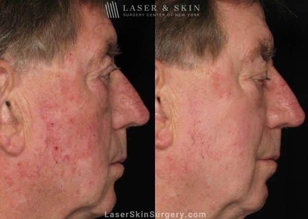 Vascular laser used to reduce visible vessels on patient’s face