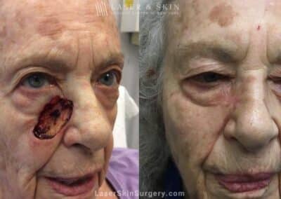 Mohs Surgery to Remove Skin Cancer