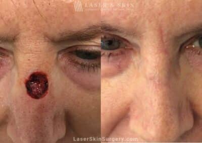 Mohs Surgery to Treat Skin Cancer