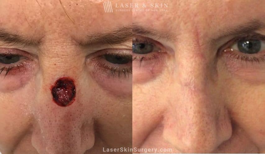 mohs closure in new york before and after mohs closure in new york before and after