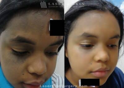 Laser Treatment for Nevus of Ota