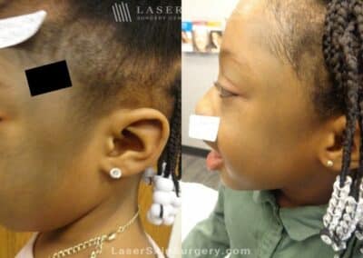 Laser Treatment for Nevus of Ota