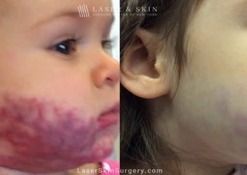 Laser Treatment for Port Wine Stain