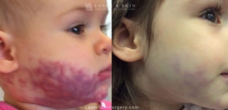 Laser Treatment for Port Wine Stain