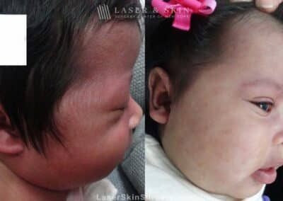Laser Treatment for Port Wine Birthmark