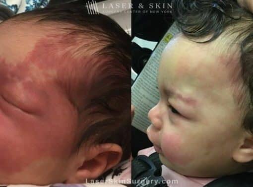 Laser treatment to reduce the appearance of a port wine birthmark from infant’s face