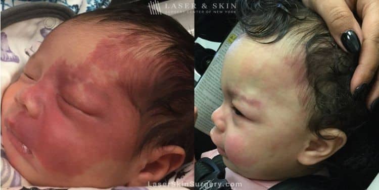 Laser treatment to reduce the appearance of a port wine birthmark from infant’s face