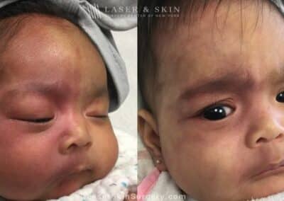 Laser Treatment for Port Wine Birthmark