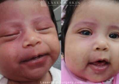 Laser Treatment for Port Wine Birthmark