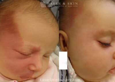 Laser Treatment for Port Wine Birthmark