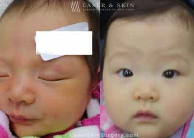 Laser Treatment for Port Wine Birthmark