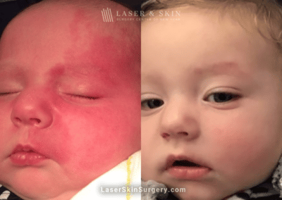 Laser Treatment for Port Wine Birthmark