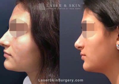 Rhinoplasty to Remove Dorsal Hump