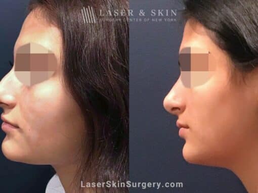 Rhinoplasty to Remove Dorsal Hump