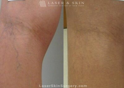 Sclerotherapy to Remove Leg Veins