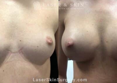 Breast Implants for Augmentation