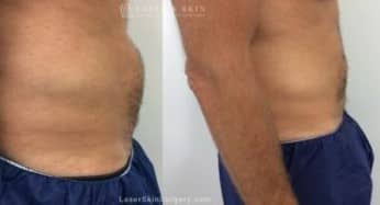 Coolsculpting for Unwanted Belly Fat