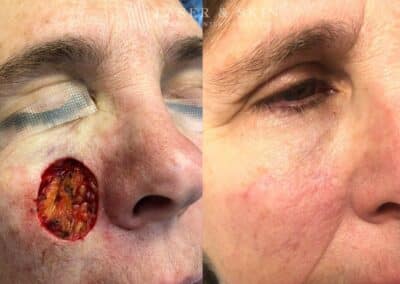 Mohs Closure for Cheek Surgery