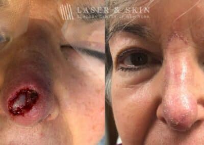 Mohs Closure for Nose Surgery