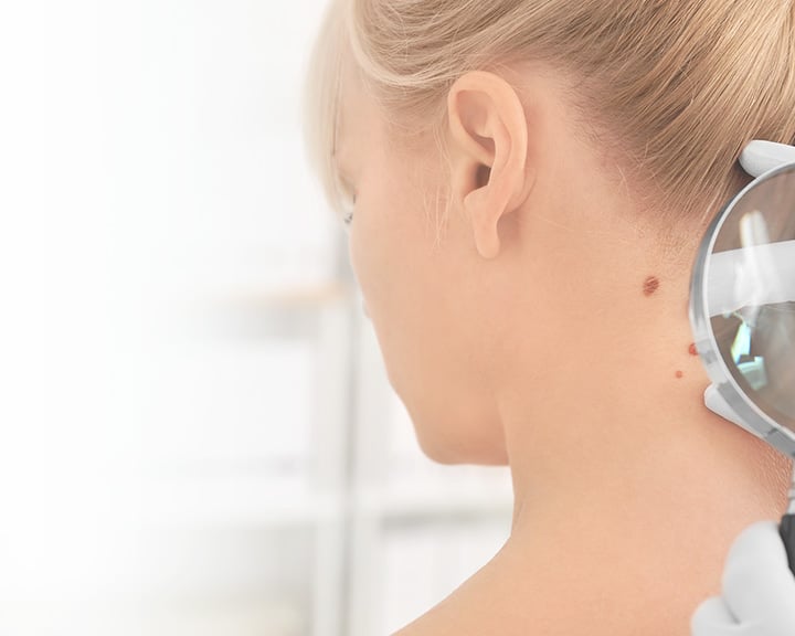 Plastic-surgery-mole-removal-Laser-Surgery-New-York-NYC-1 mole removal in new york