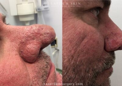 Laser Treatment for Rhinophyma