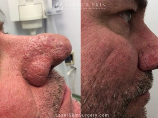 Laser Treatment for Rhinophyma