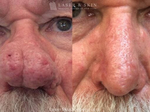 Laser Treatment for Rhinophyma