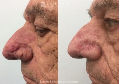 Laser Treatment for Rhinophyma