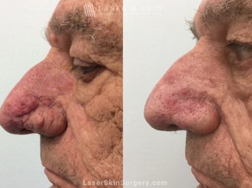 Laser Treatment for Rhinophyma