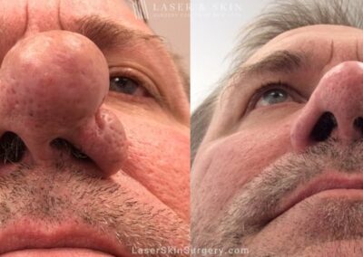 Laser treatment to address symptoms of rhinophyma and improve the appearance of the nose