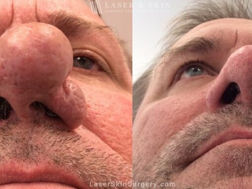 Laser treatment to address symptoms of rhinophyma and improve the appearance of the nose