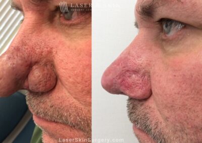 Laser Treatment for Rhinophyma