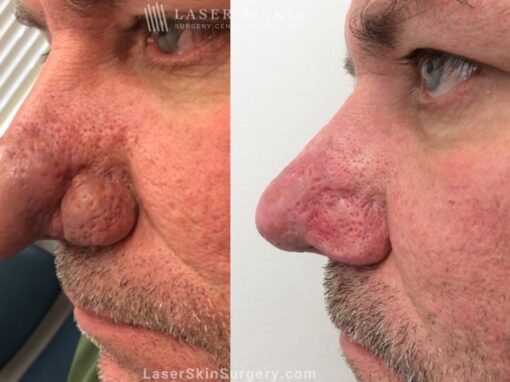 Laser Treatment for Rhinophyma