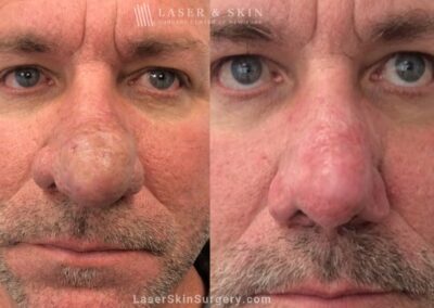 Laser Treatment for Rhinophyma