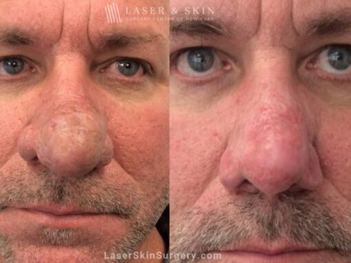 Laser Treatment for Rhinophyma