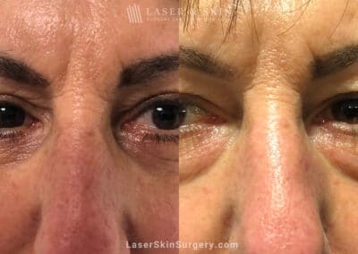 Lower Blepharoplasty to Refresh Eyes