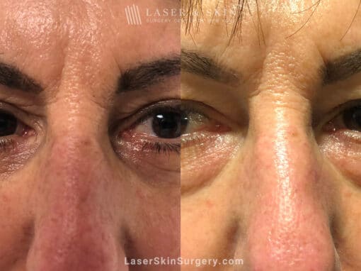 Lower Blepharoplasty to Refresh Eyes