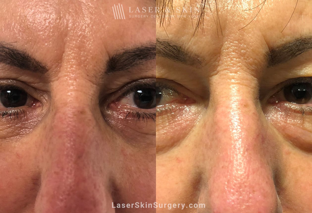 eyelid surgery before and after